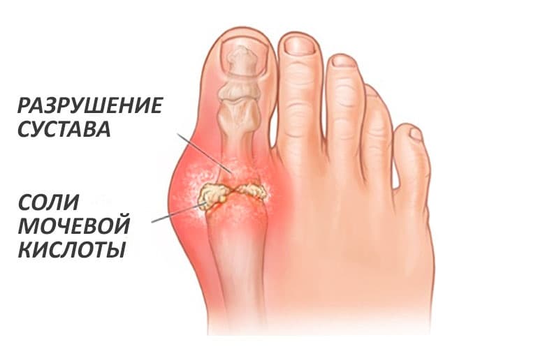 Сустав стопы - подагра