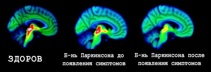 Изменение мозга при болезни Паркинсона