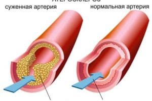 Современный взгляд на генез атеросклероза