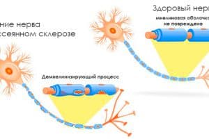 Реально ли вылечить рассеянный склероз?