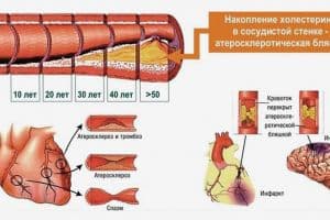 Диалог о клинических рекомендациях по лечению атеросклероза