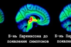 Наша микробиота может быть связана с деменцией, болезнью Паркинсона и рассеянным склерозом