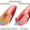 Опасен ли повышенный уровень холестерина?